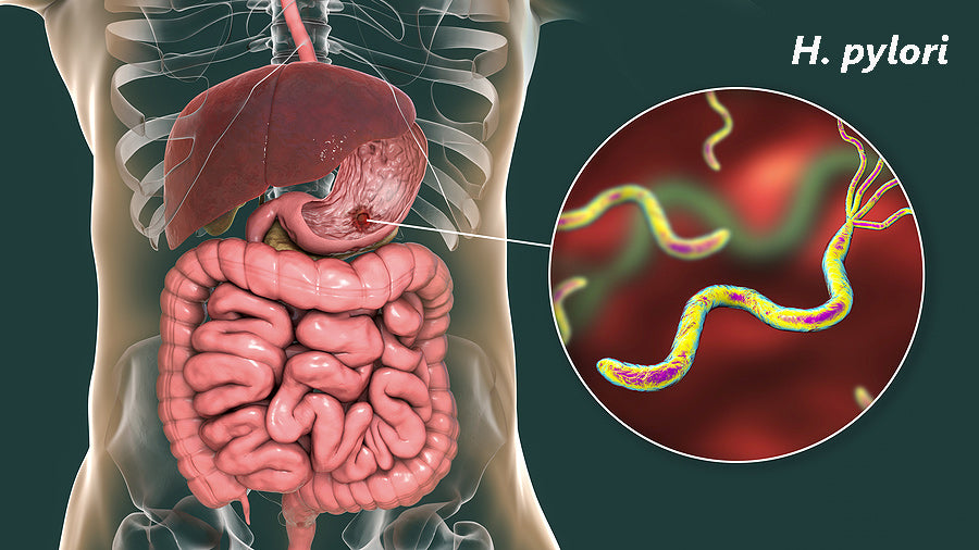 Helicobacter Pylori – Why It Can Be a Problem (and How to Fix It) – Aviva Natural Health Solutions
