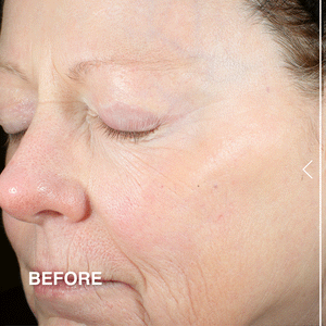 Before & After Derma-E Peptides & Collagen treatment